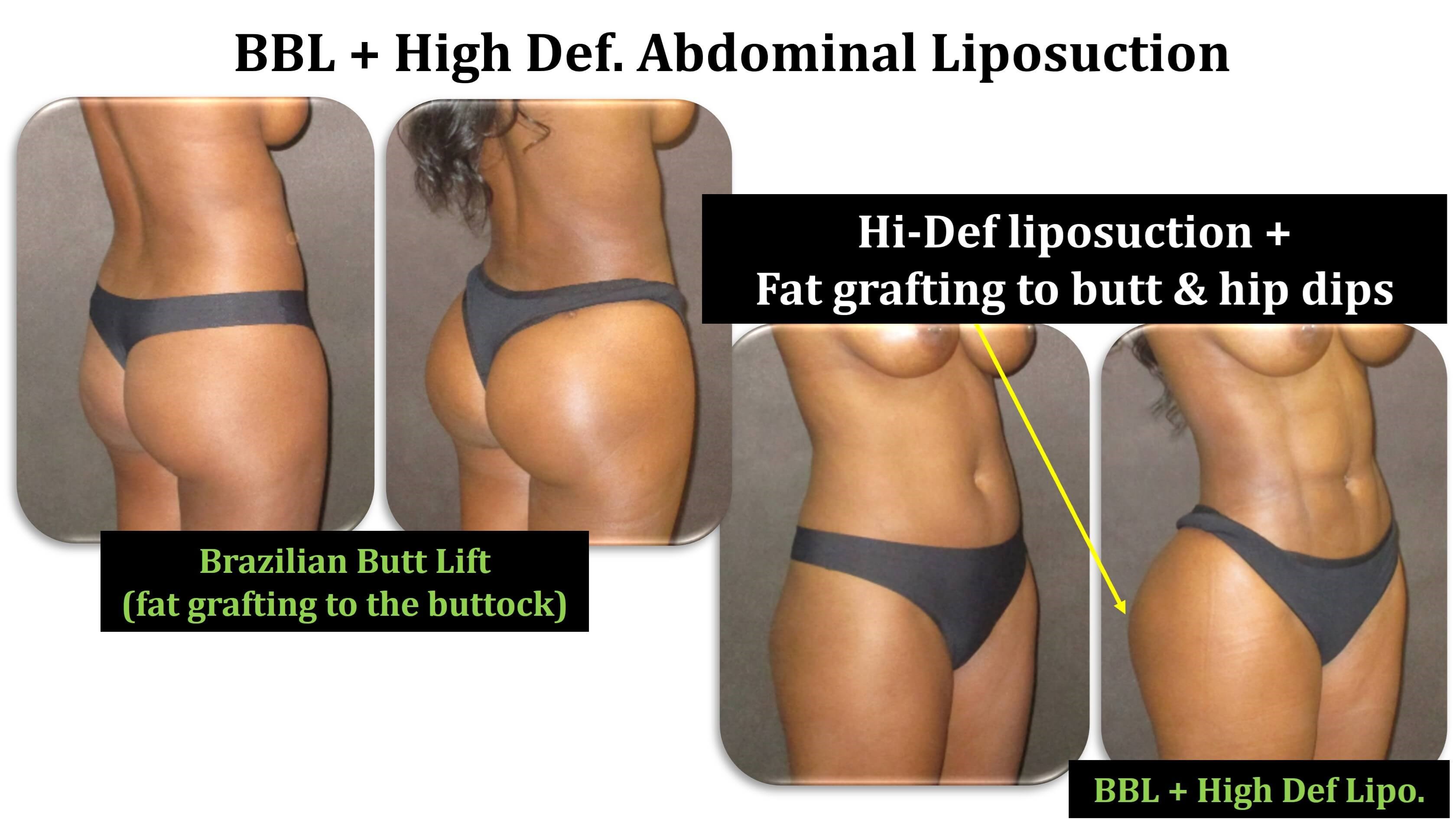 before and after butt and hips